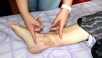 Deri Nakli Ameliyatı ve Riskleri