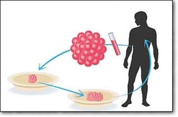 Otolog Kök Hücre Nakli Ameliyatı ve Riskleri